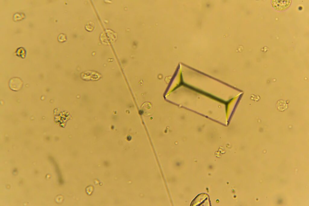 struvitové kryštály pod mikroskopom